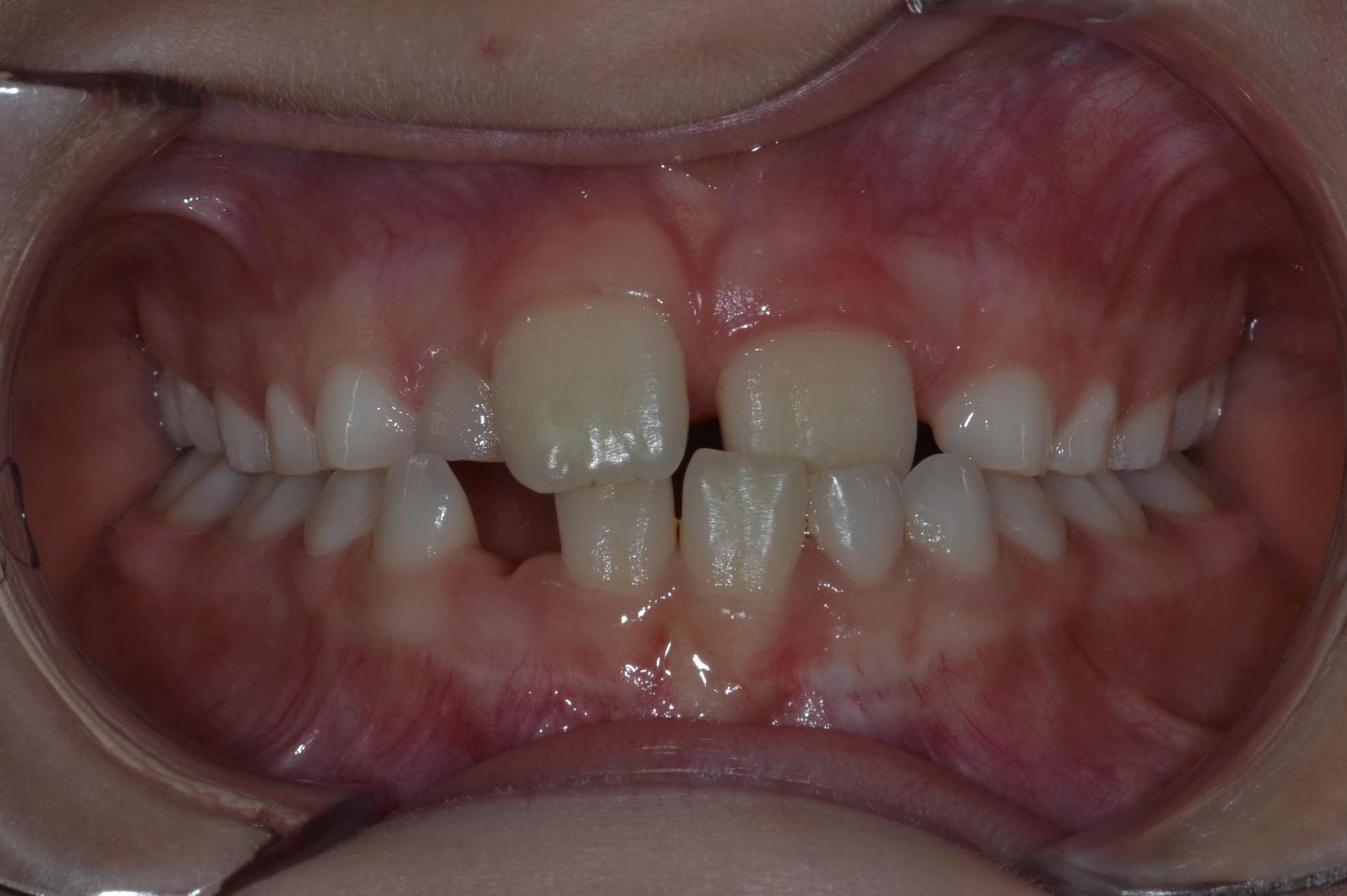 The success of the Invisalign Treatment - Dr Normand Bach