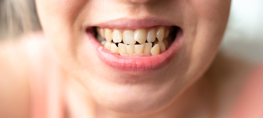 Dents mal alignées, chevauchement machoires: Risques pour votre santé