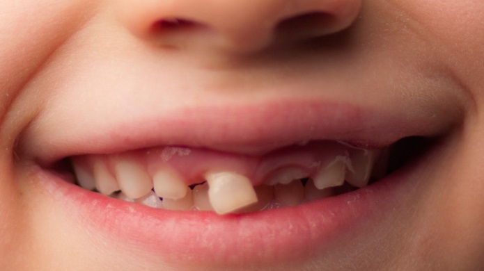 Dents en avant : les conséquences de la tétine - Dentiste pour Enfants