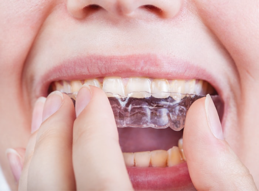 Protège-dents Orthodontie